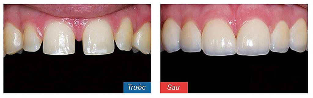 bọc răng sứ có đau không